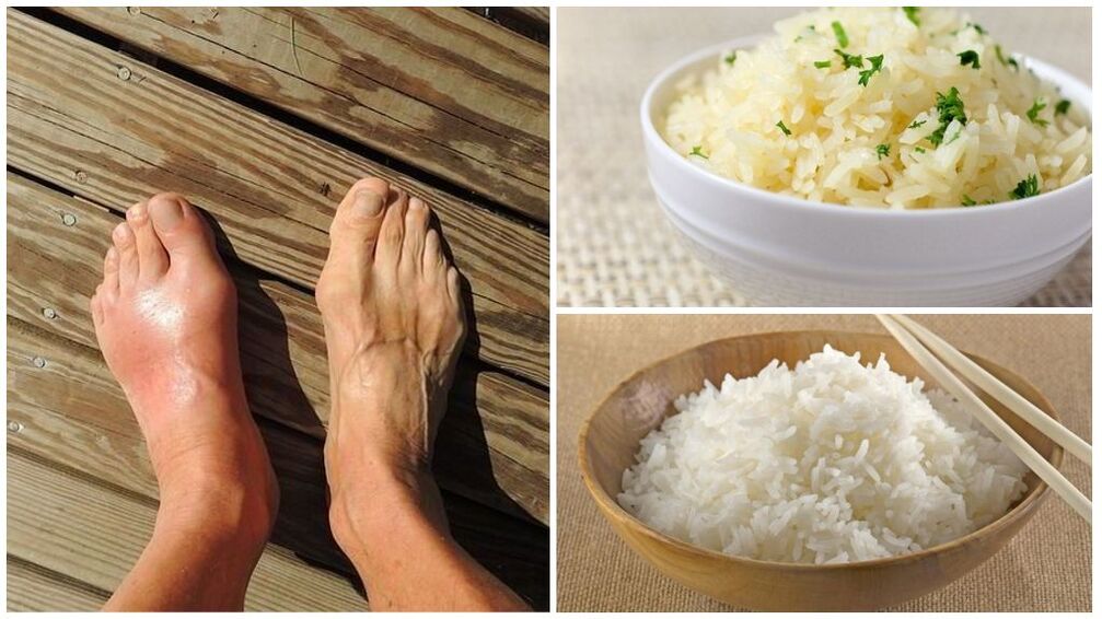 Diet berbasis nasi direkomendasikan untuk pasien asam urat. 